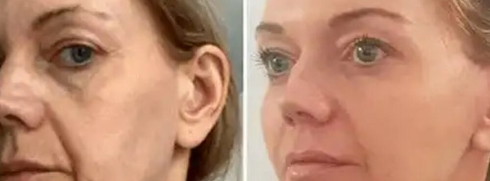 BreastAugmentation